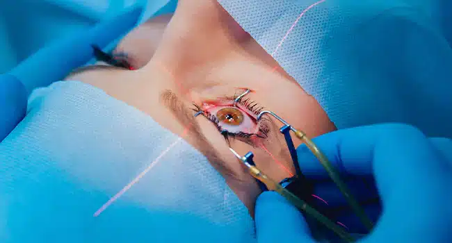 Understanding the LASIK Process