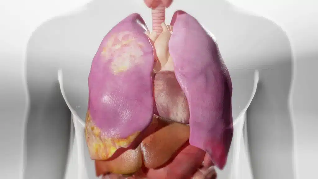 Why It's So Hard to Catch Mesothelioma Early