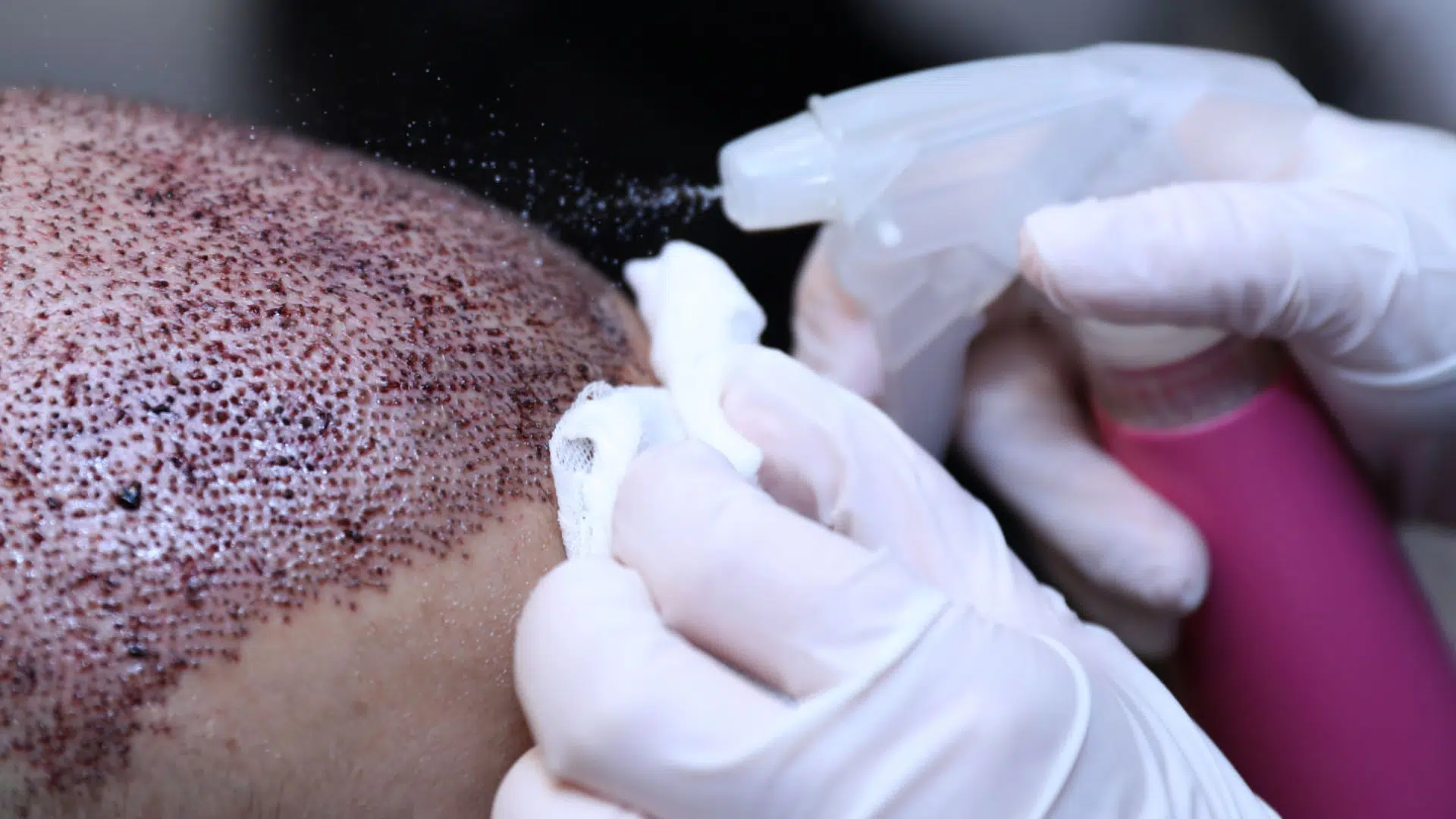 Aftercare Products for hair transplant