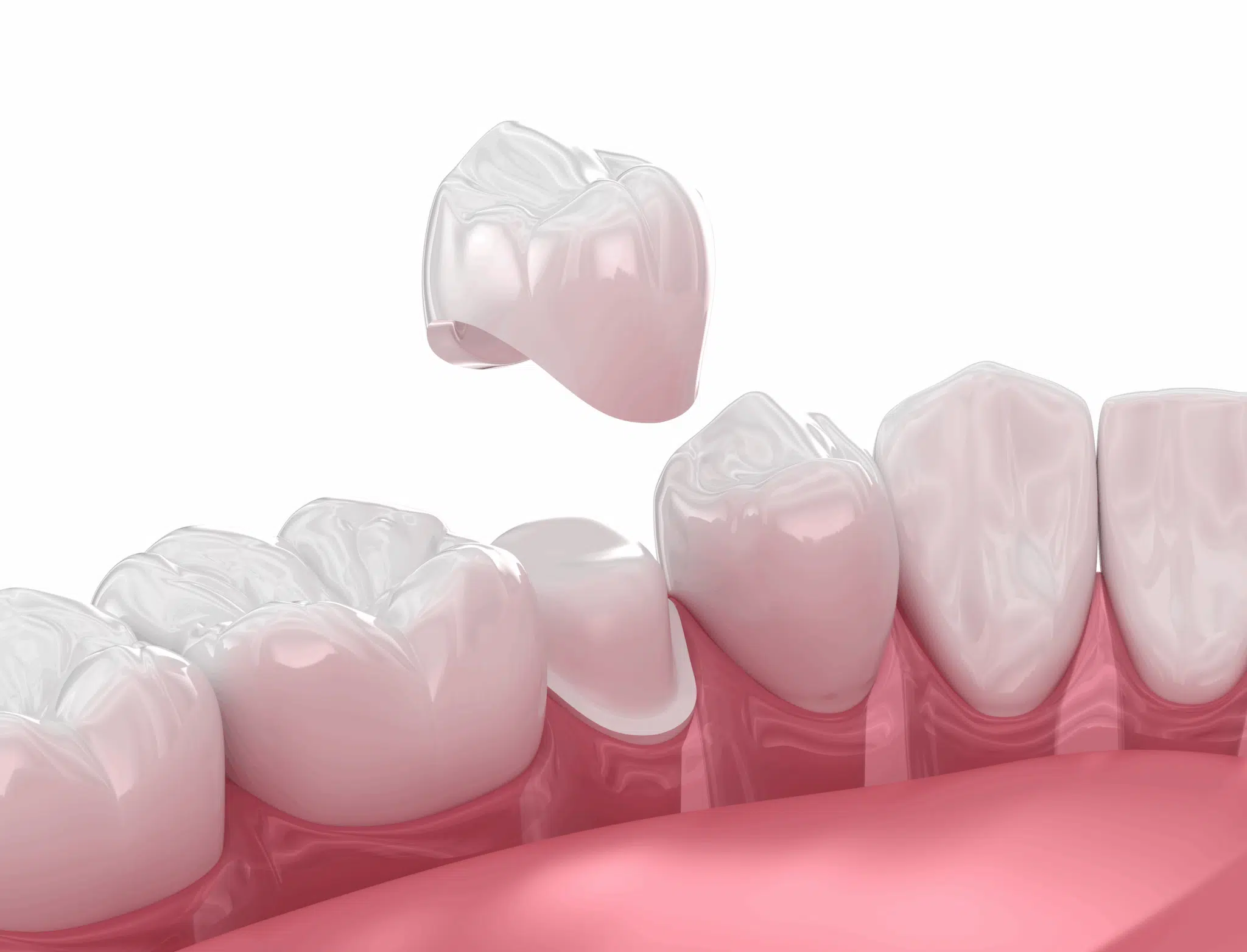 Dental Crowns