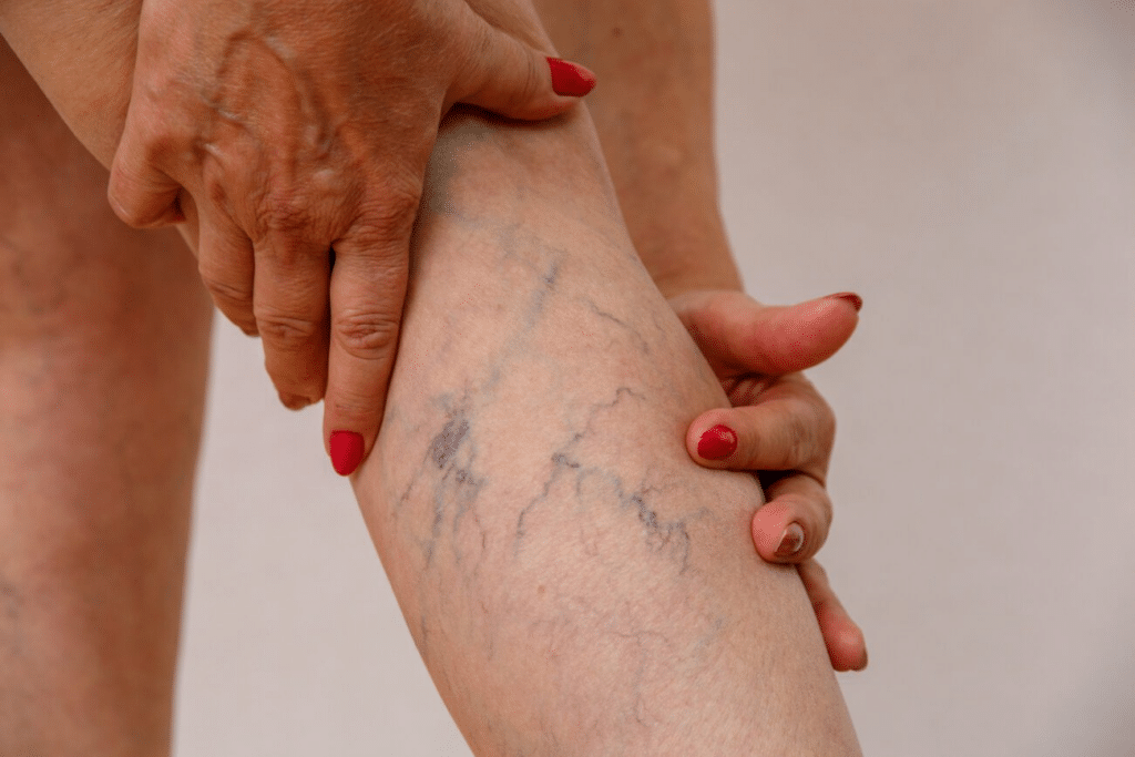 How to Reduce Spider Veins and Improve Leg Health