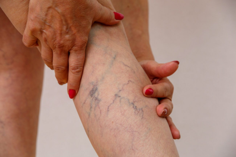 How to Reduce Spider Veins and Improve Leg Health