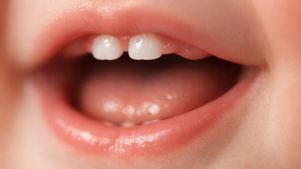 What If Baby Gets Upper Teeth First